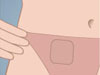 Contraceptive Patch Illustration